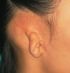 Dị tật tai nhỏ bẩm sinh: Những điều cần biết